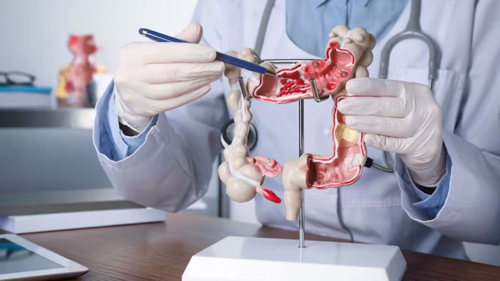 Casos de cáncer de colon aumentan entre adultos jóvenes
