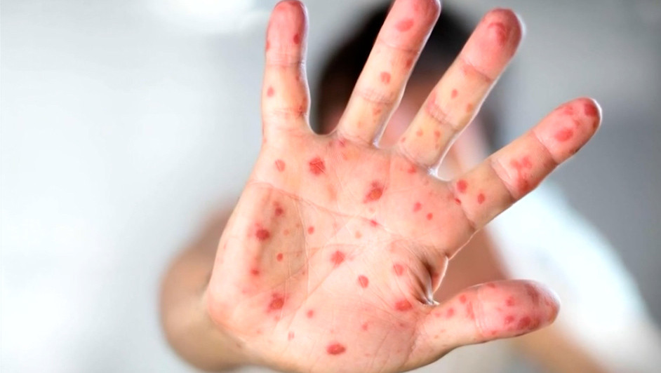 Autoridades refuerzan prevención de sarampión en escuelas de Chalco