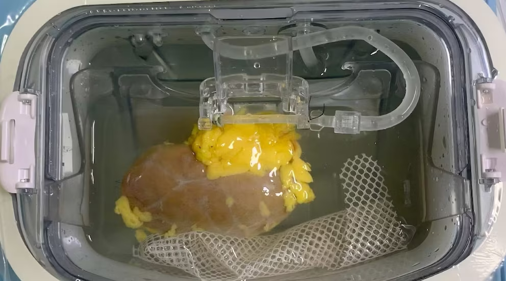 Un avance experimental logró un riñón apto para cualquier paciente