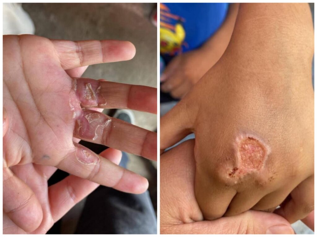 Padrastro quema las manos a dos niños de 6 y 4 años