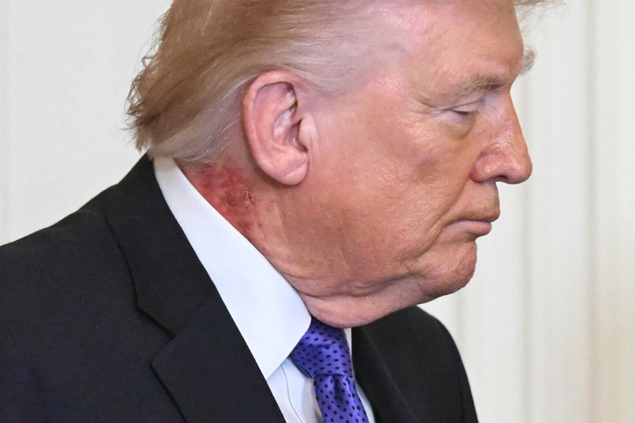 Trump luce nueva mancha roja en el cuello, antes eran las manos